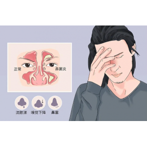 感冒竟是鼻竇炎的元兇？？？