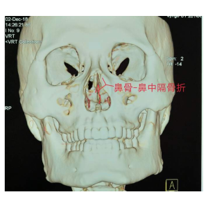 貴陽銘仁耳鼻喉醫(yī)院提醒您：鼻子很脆弱，要好好保護(hù)