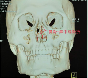 十歲小孩被書(shū)本砸破鼻子，(圖1)