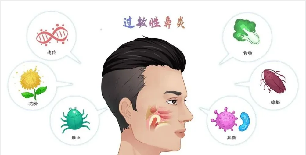 銘仁耳鼻喉專家分享：如何一招解決過敏性鼻炎的打噴嚏流鼻涕！(圖1)