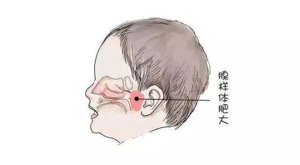 銘仁耳鼻喉專家分享：兒童腺樣體肥大怎么治療比較好？(圖1)