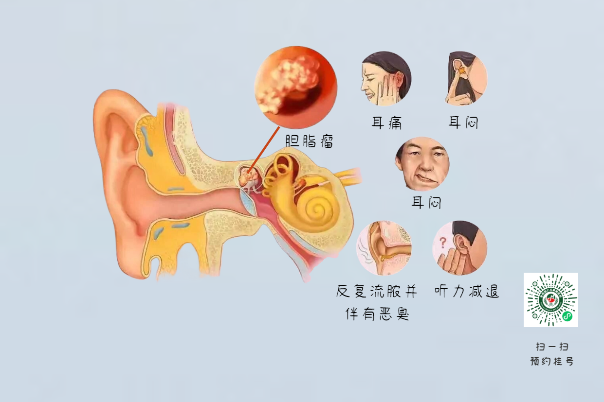 手術(shù)沒做干凈，術(shù)后3年顱內(nèi)竟發(fā)現(xiàn)巨大膽脂瘤！(圖6)
