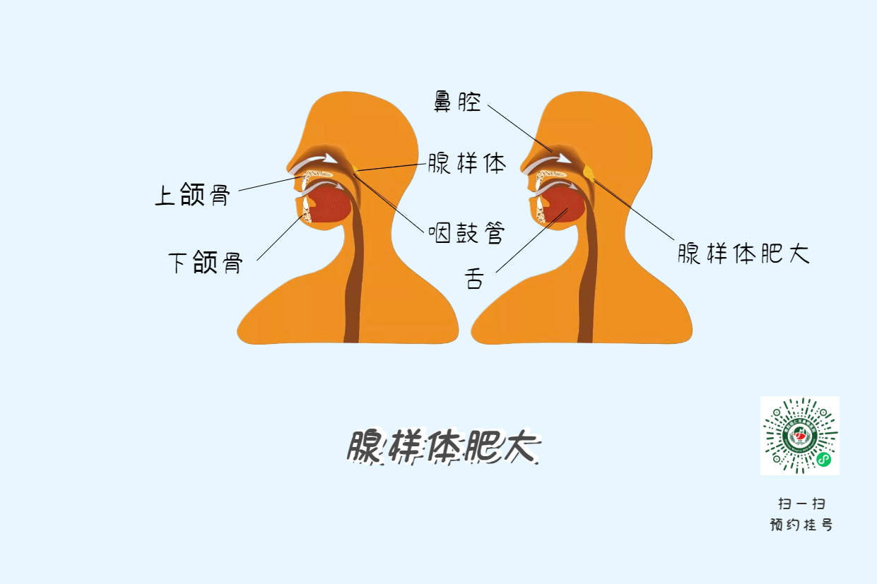 暑假來(lái)了，孩子腺樣體肥大到底切不切？(圖4)