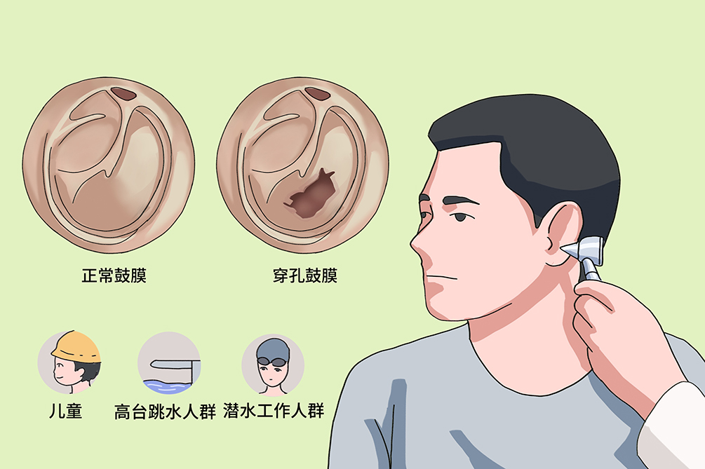 鼓膜穿孔不及時治療，會導致聽力下降，甚至引發(fā)顱內(nèi)感染？(圖3)