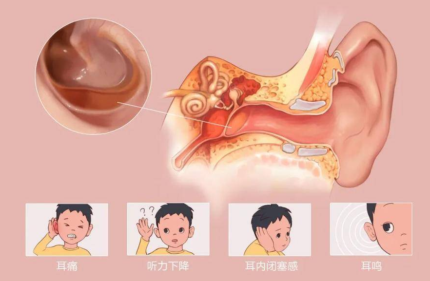  夏季游泳，謹(jǐn)防中耳炎“找麻煩”！(圖3)