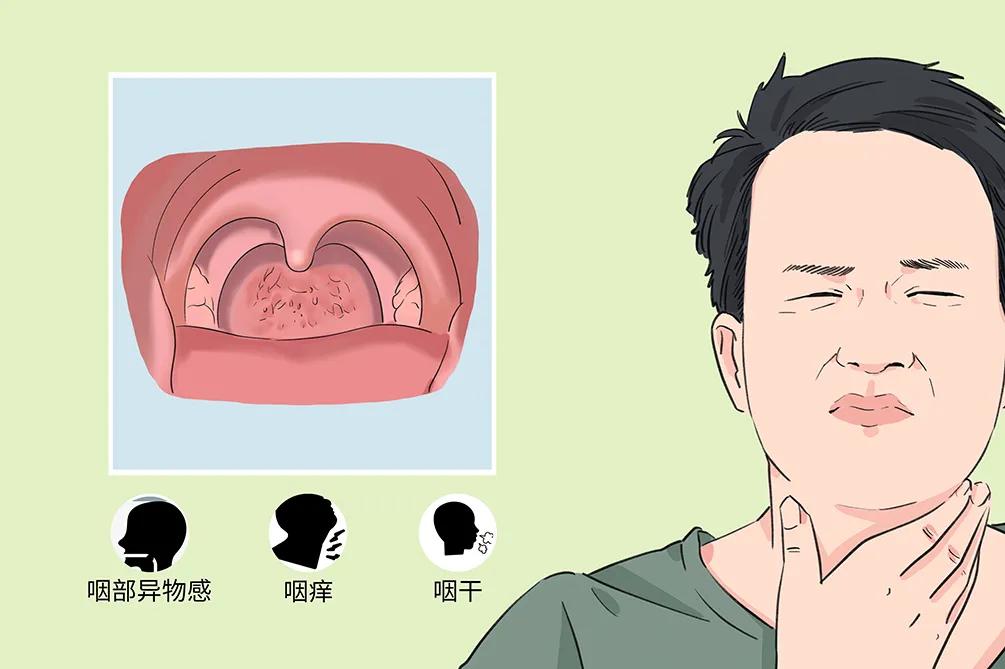 慢性咽炎的困擾：咽干、咽痛、咽部異物感(圖2)