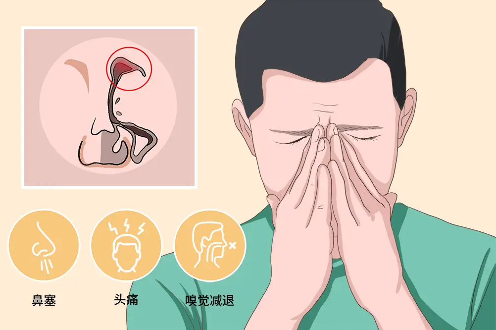 鼻竇炎不是小病，拖延治療，當心三大并發(fā)癥！(圖1)