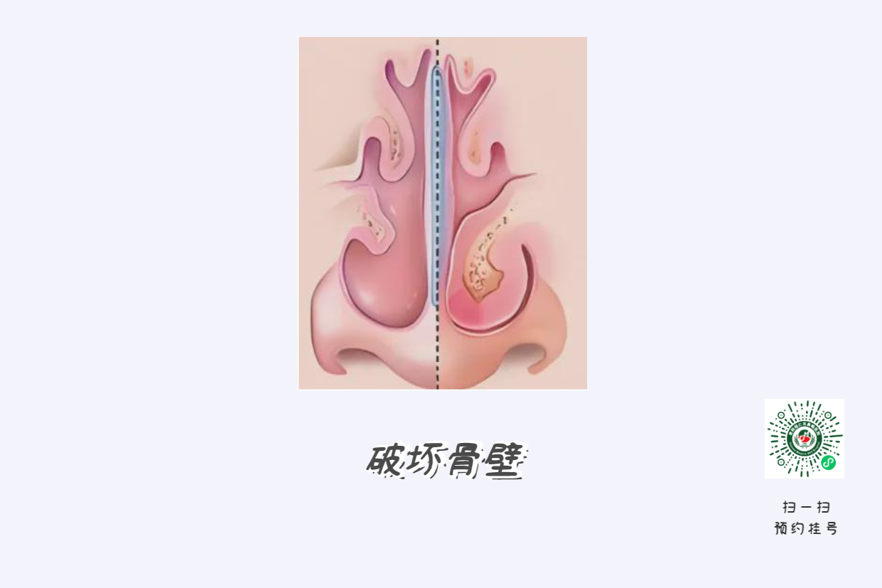 患上鼻竇炎不可小覷，當心五大并發(fā)癥！(圖2)
