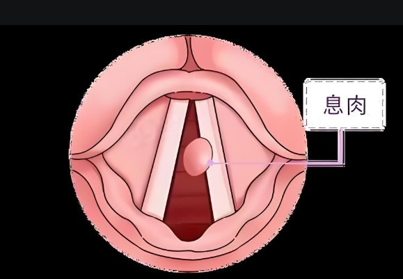 聲音嘶啞、嗓子難受，聲帶息肉不可小覷(圖1)