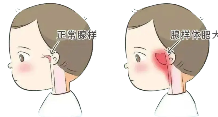 腺樣體手術(shù)風(fēng)險(xiǎn)大嗎？麻醉會(huì)影響孩子智商嗎？(圖1)