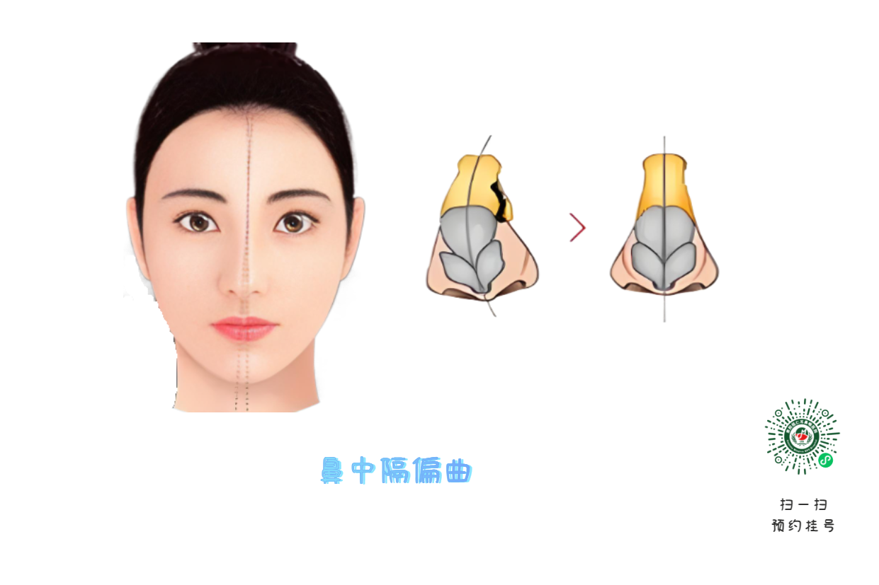別把鼻塞當(dāng)小事 它可能是鼻腔內(nèi)的“隱形戰(zhàn)爭”(圖1)