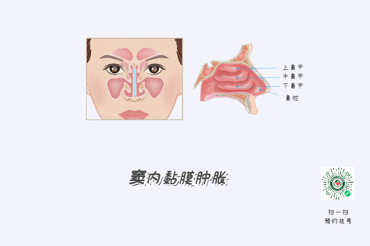 鼻竇炎頭痛有特點(diǎn)！這個(gè)位置痛要當(dāng)心(圖4)