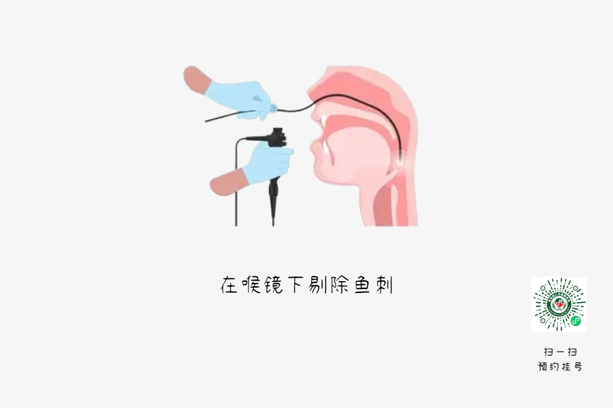 喉嚨卡魚刺？喝醋吞飯都是致命錯誤(圖2)