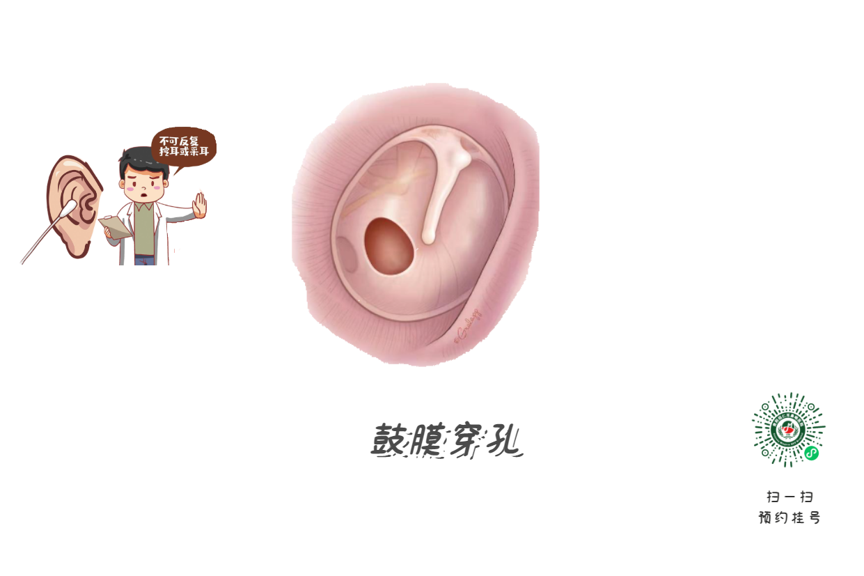 掏耳朵竟致顱內(nèi)感染？這5個(gè)習(xí)慣快改掉(圖2)